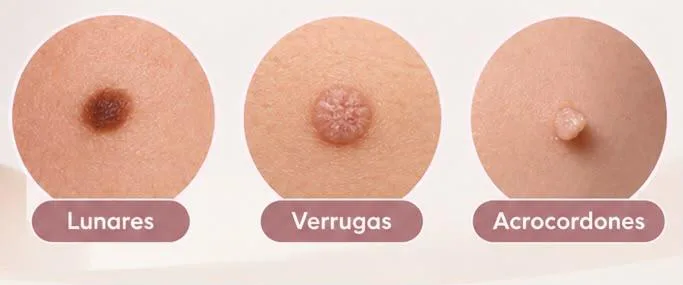 Lunares, verrugas y acrocordones en la piel antes de su eliminación